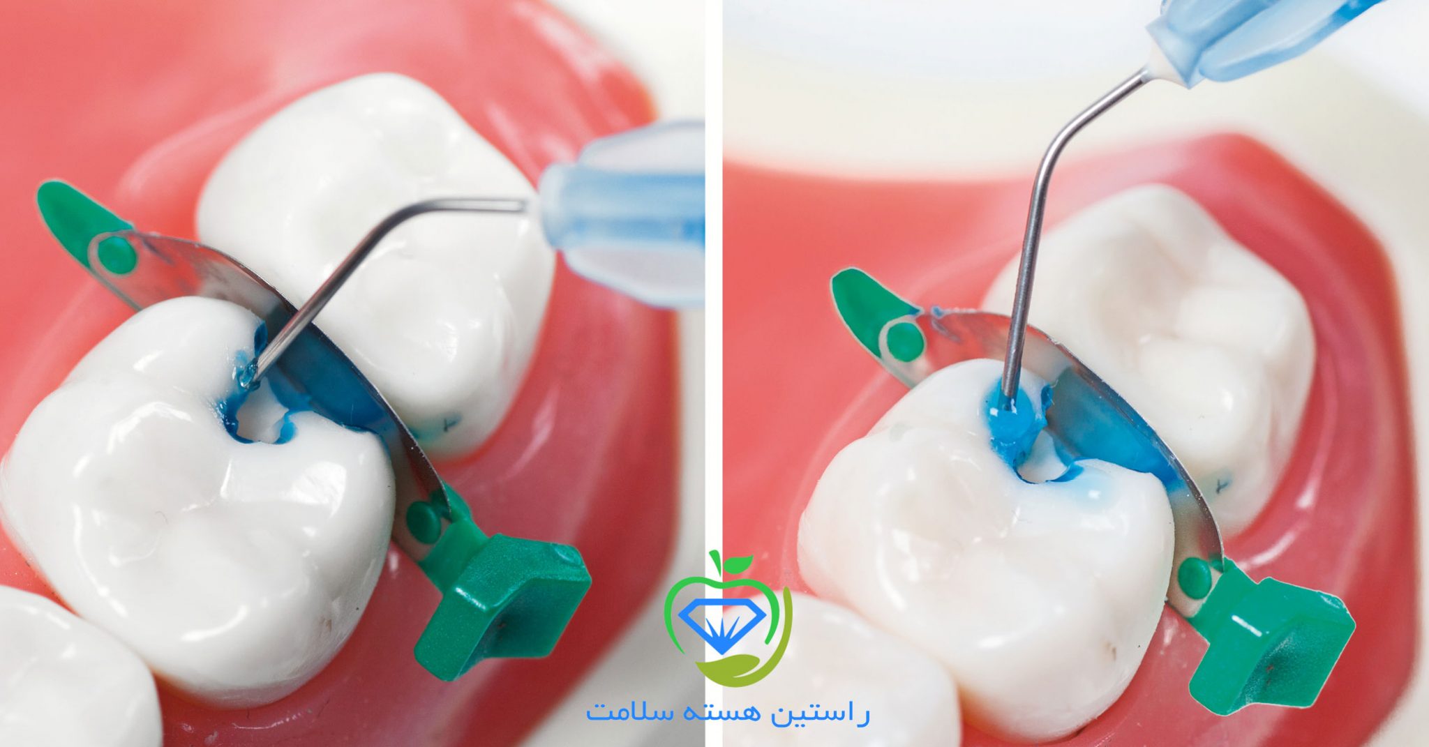 آشنایی با انواع اسید اچ و کاربردهای آن راستین هسته سلامت