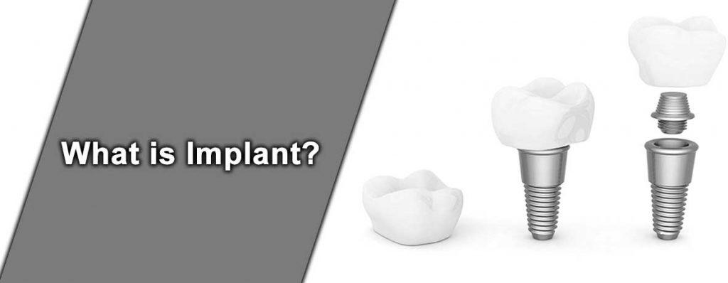 ایمپلنت چیست