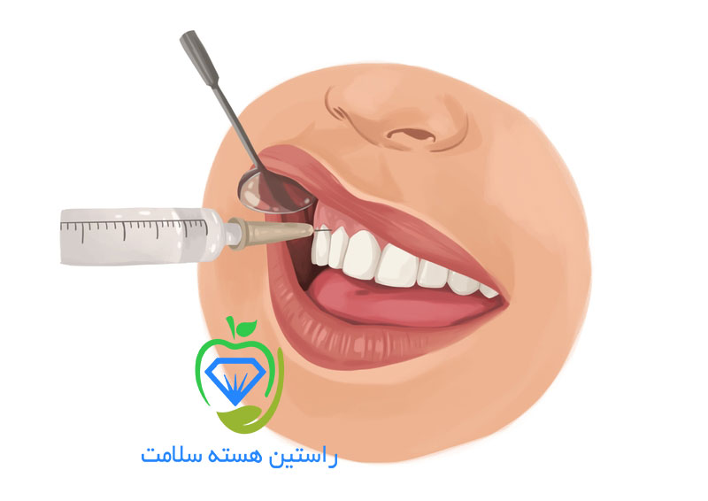 کاربرد سرسوزن دندانپزشکی