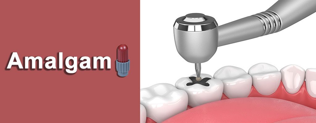 آمالگام چیست