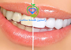بلیچینگ دندان چیست؟ مزایا و معایب آن