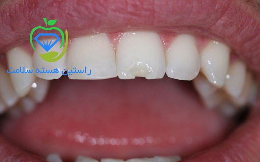 ترمیم کامپوزیت دندان امکان پذیر است