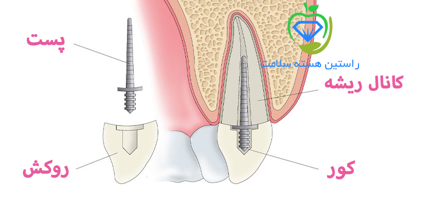 پست و کور دندان چیست